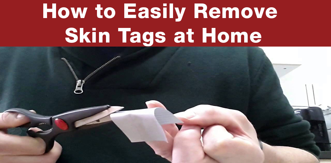 How To Remove Anal Skin Tags 101