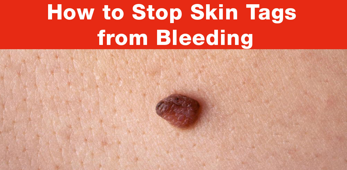 stop skin tags from bleeding