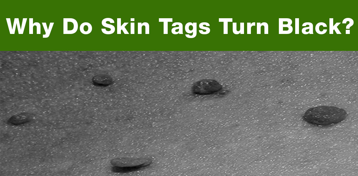 how to remove a black skin tag