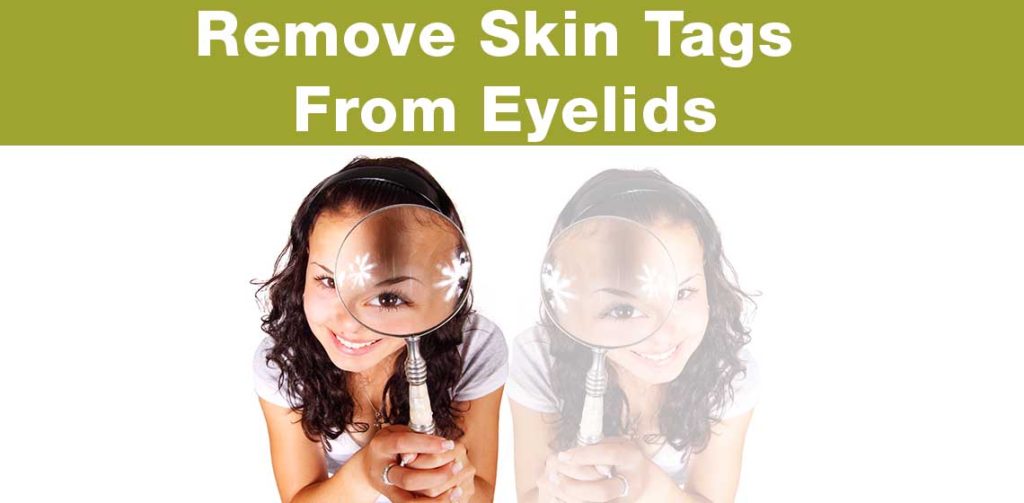 How to Remove Skin Tags From Eyelids