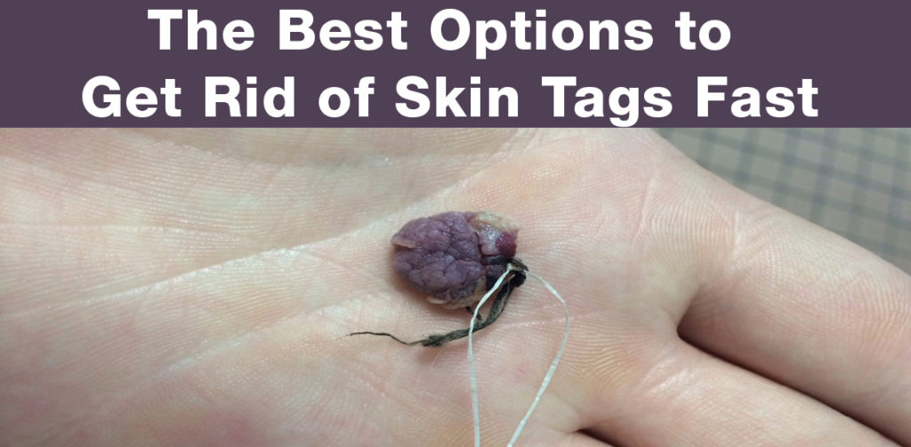 get rid of skin tags fast